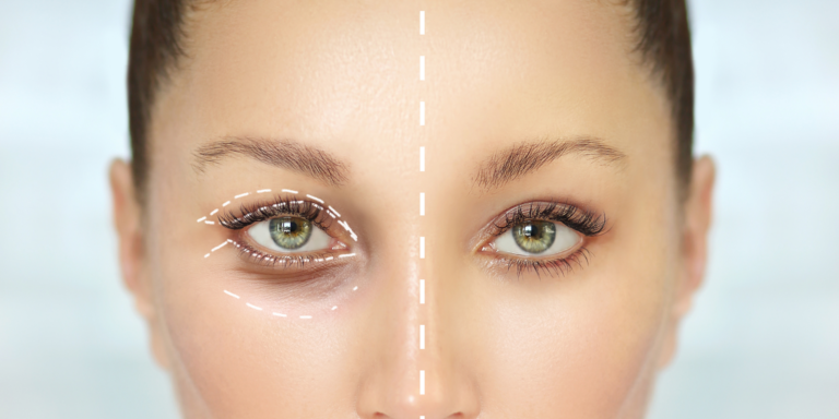 NeoGen Bold Eyes treatment is a non-surgical cosmetic procedure that uses radiofrequency technology to tighten the skin around the eyes, reduce puffiness, and diminish fine lines and wrinkles.